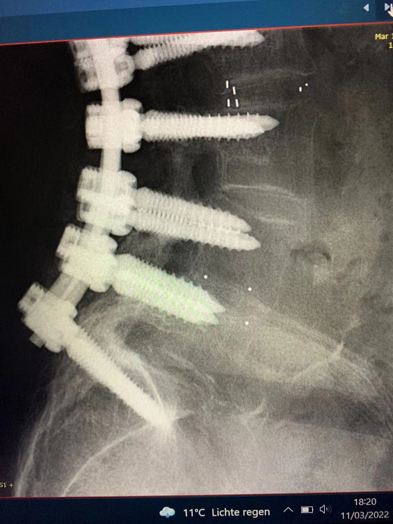 mais recente caso da empresa sobre Fixação interna cirúrgica espinal bem sucedida